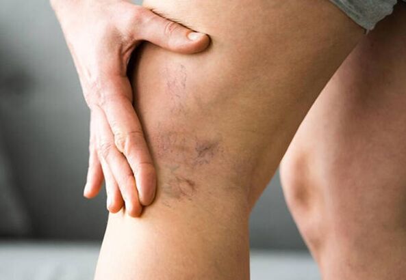 Levicose protects the legs from developing varicose veins