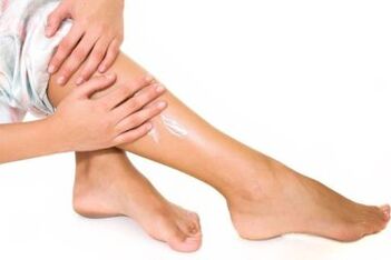 Varicose veins