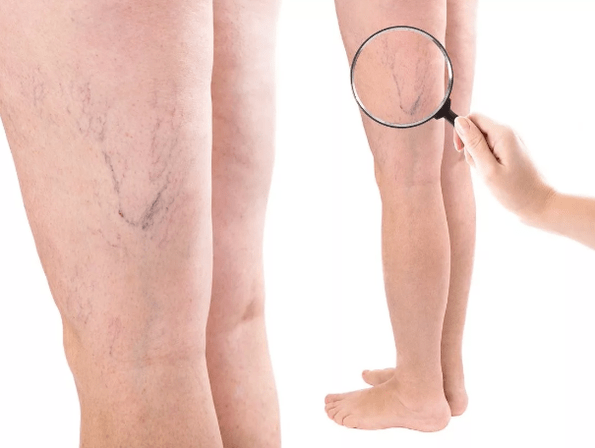 Different veins in women