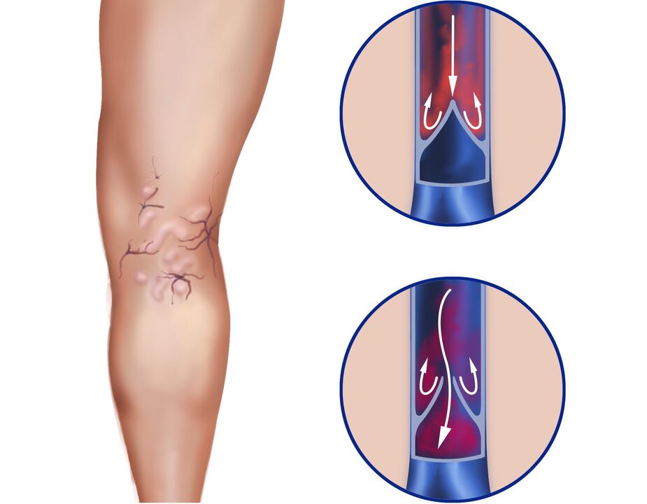 What happens to varicose veins
