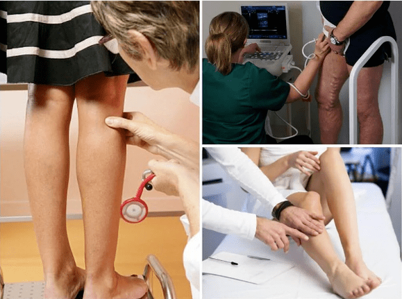 Varicose veins
