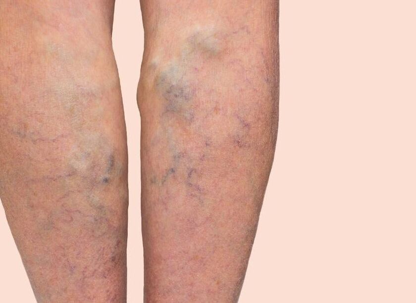 What varicose veins seem