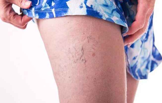 Varicose veins