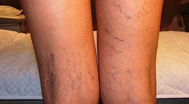 How to treat the varicose enlargement in women in women