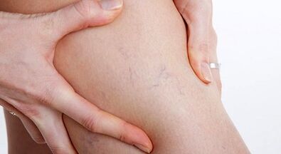 Signs and symptoms of varicose veins