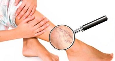The causes of varicose veins