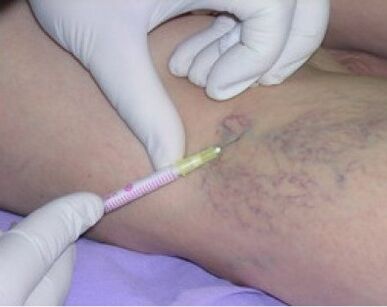 varicose veins