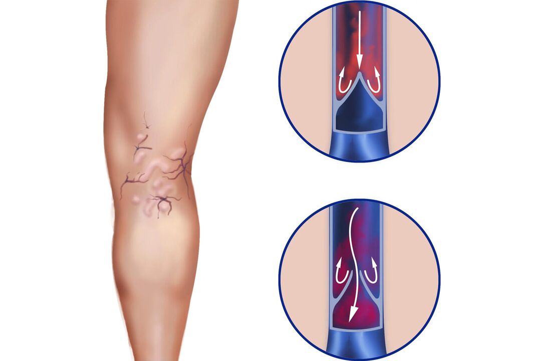 varicose veins of the legs