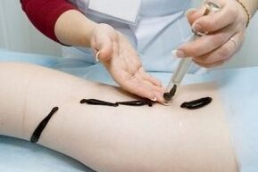 application of leeches to treat varicose veins
