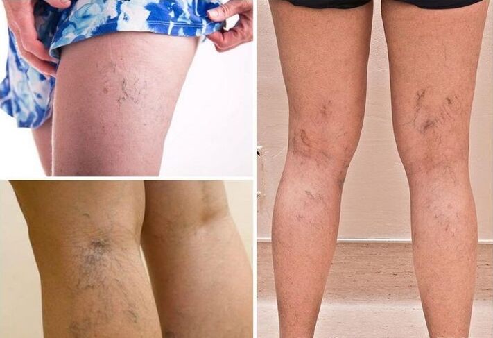 varicose veins of the legs