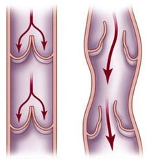 A healthy vein and impaired blood flow in a dilated vein