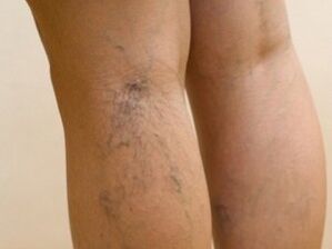 Bulging veins under the skin are a symptom of varicose veins in the legs