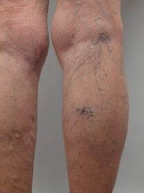 In varicose veins of the lower extremities, the tortuous veins protrude above the surface of the skin